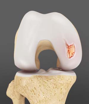 Articular Cartilage Injury