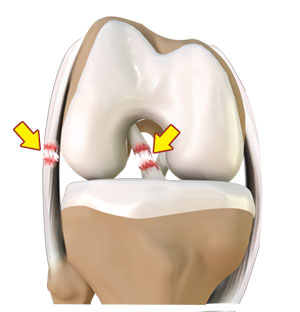 Multiligament Knee Injuries