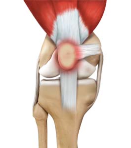 Runner's Knee