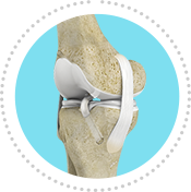 ACL Reconstruction