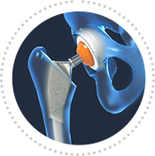 Hip Replacement Surgery